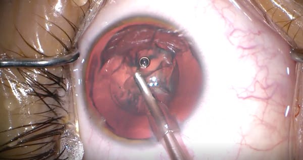 Persistent Fetal Vasculature and Congenital Cataract thumbnail
