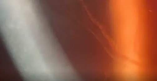 Blood Flow in Corneal Scar
