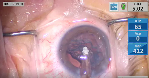 Nucleus Fragmentation With iStent Implantation
