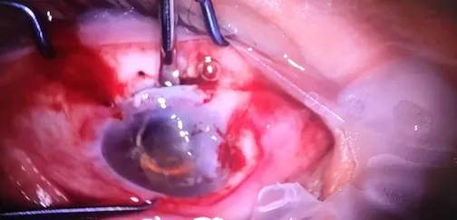 Manual Small-Incision Cataract Surgery