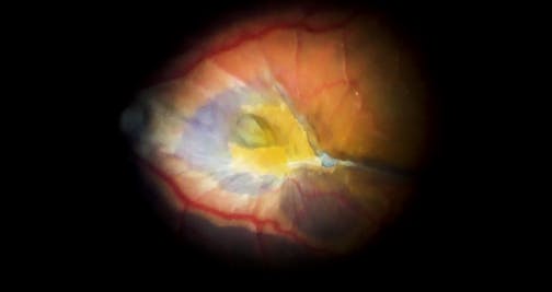 Challenging Case of Macular Pucker With Double Peel of Epiretinal and Internal Limiting Membranes