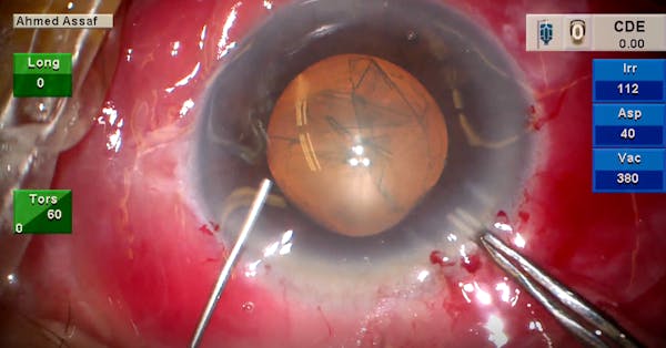 Cataract with PXF and Zonular Laxity thumbnail