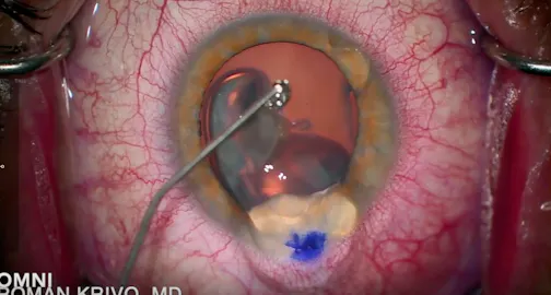 OMNI Canaloplasty and Goniotomy