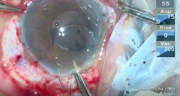 Intraocular Lens-Sling Technique thumbnail