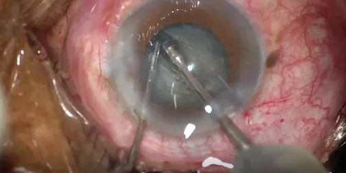 Phaco Tips Compilation