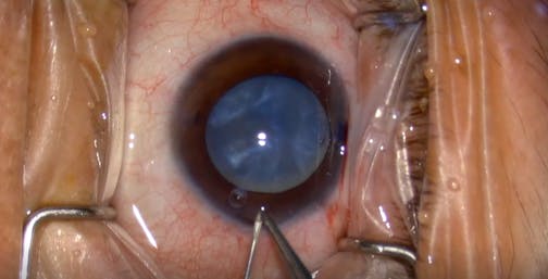 Double Rhexis for White Cataracts