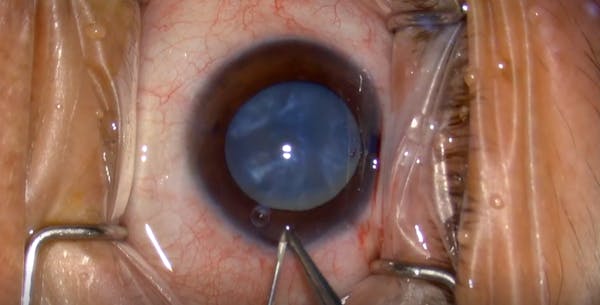 Double Rhexis for White Cataracts thumbnail