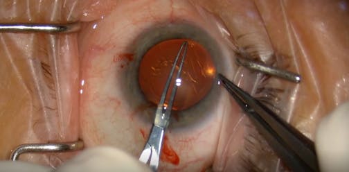 Keeping Cataract Surgery Routine