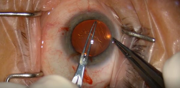Keeping Cataract Surgery Routine thumbnail