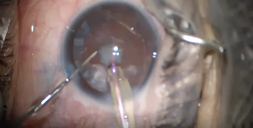 My Journey in Cataract Surgery