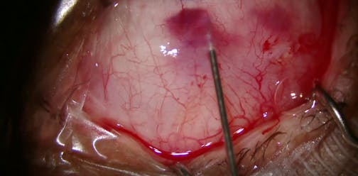 Partial Open Transconjunctival Ab Externo Xen Gel Stent Placement