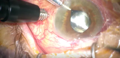 Sunrise Over Choroidal Mountains: A Choroidal Effusion Drainage Technique