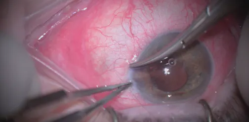 Management of Recurrent Hyphemas