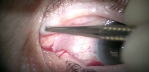 Drug Delivery and Glaucoma: Dextenza for Xen Patients