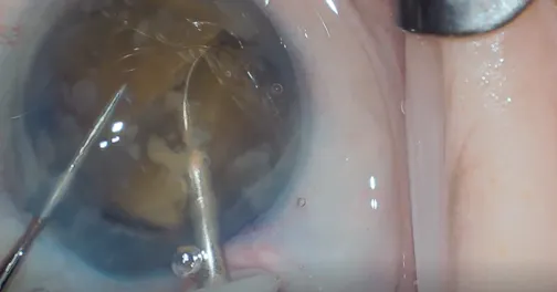 IOL Scaffold and miLoop for Dense Nuclear Cataract