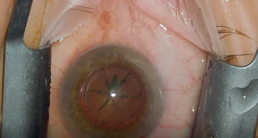 Posterior Capsule Needle Tract