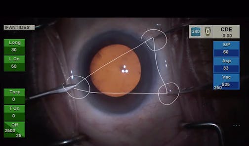 Bread-and-Butter Cataract Surgery