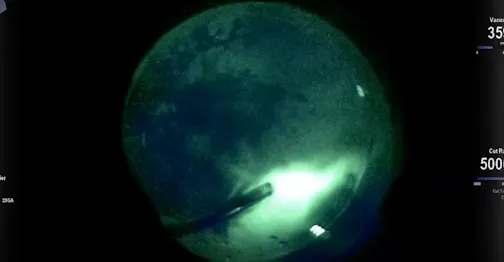 Vitreoretinal Surgery Under Fluoroscopic View With Alcon Ngenuity