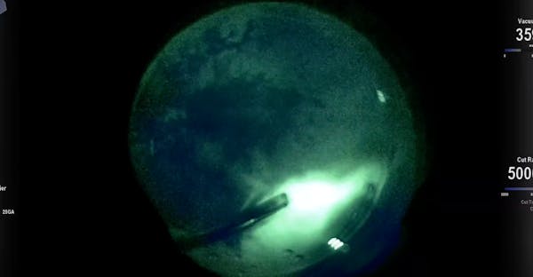 Vitreoretinal Surgery Under Angio-Fluoroscopic View With Alcon Ngenuity thumbnail