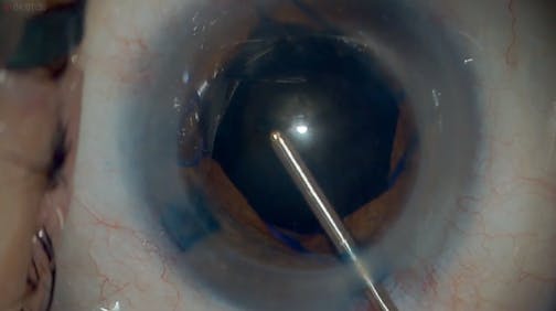 Black Cataract: Modified Extracapsular Technique With miLoop