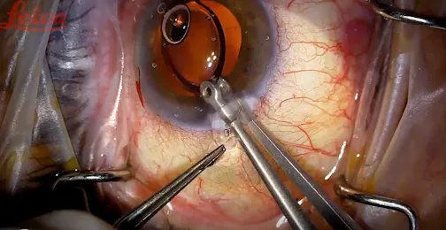Lens Explantation Using Youssef's Explantation Forceps