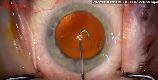 Cortical Cleanup With J Cannula