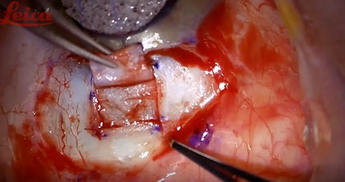 Routine Trabeculectomy - Eyetube