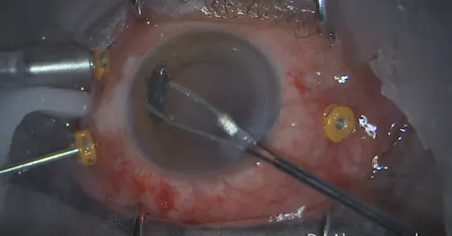 Traumatic Endophthalmitis With IOFB