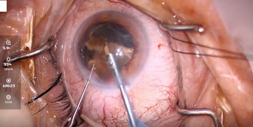 Dense Hard Cataract