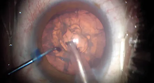 Immature Traumatic Cataract: Prolapse Out-of-Bag Technique