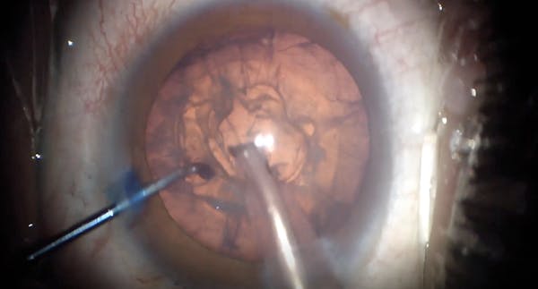 Immature Traumatic Cataract: Prolapse Out-of-Bag Technique thumbnail