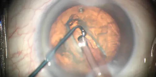 Groove Low and Crack the Nucleus: Second Case