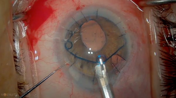 Cataract Extraction Following Penetrating Keratoplasty thumbnail