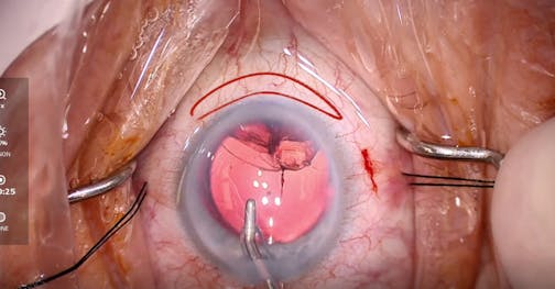 iStent 360-Degree Blanching