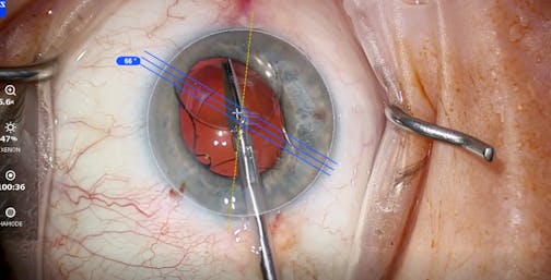 Scaffold Technique for Safer IOL Exchange Surgery