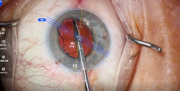 Scaffold Technique for Safer IOL Exchange Surgery thumbnail