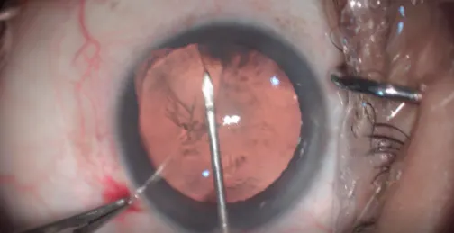 Bilateral Iris Coloboma