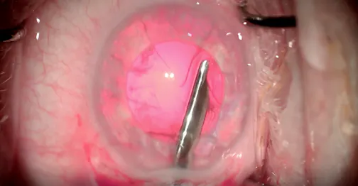 Aniridia IOL Implantation in the Eye of a Patient With Albinism