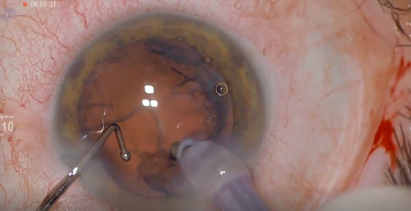 Routine Cataract Surgery With 3D Visualization thumbnail
