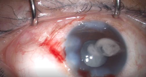 Immediate Outflow After MIGS