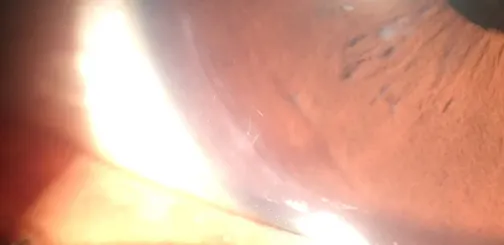 Removal of Intraocular Fiber