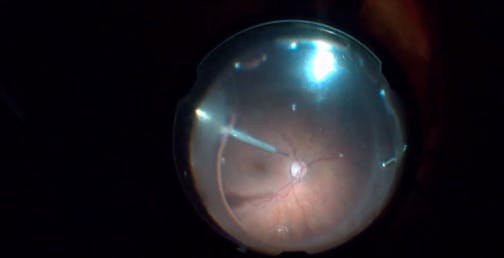 Combined Procedure in Pseudophakic Patient