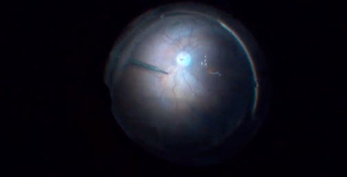 Management of Recurrent Retinal Detachment