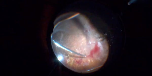 Severe PDR With TRD thumbnail