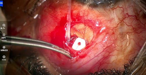SITS: Small-Incision Tube Surgery