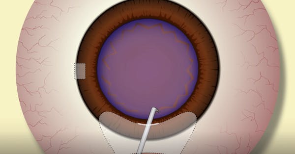 MSICS for the Phaco Surgeon thumbnail