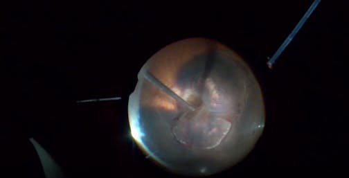 Recurrent Subretinal Hematoma