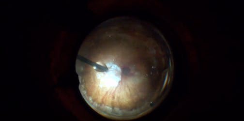 Subretinal Injection of tPA Myopic Staphyloma