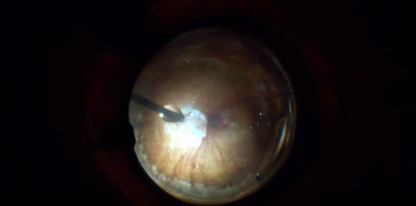 Subretinal Injection of tPA Myopic Staphyloma thumbnail