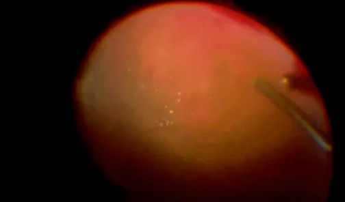 Lens-Sparing Vitrectomy for Dense Diabetic Vitreous Hemorrhage